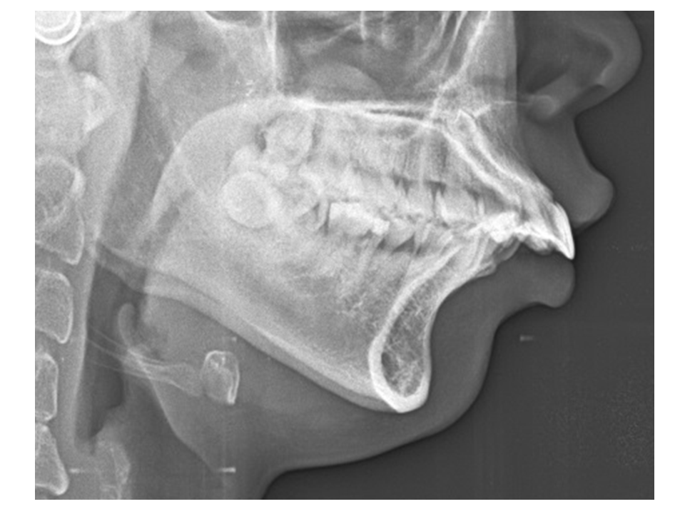 正顎手術前,牙齦外露X光片